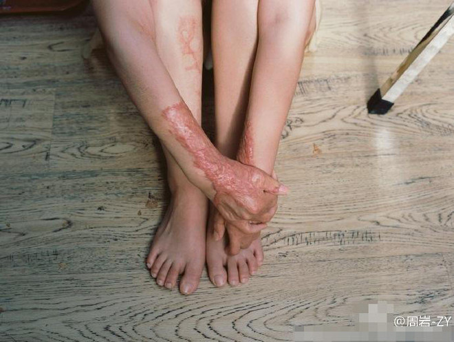 Bộ ảnh của cô gái bị bạn học tẩm xăng đốt gây sốt ở Trung Quốc ảnh 5