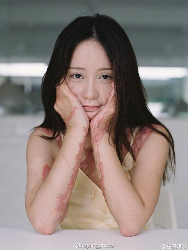 Bộ ảnh của cô gái bị bạn học tẩm xăng đốt gây sốt ở Trung Quốc ảnh 2