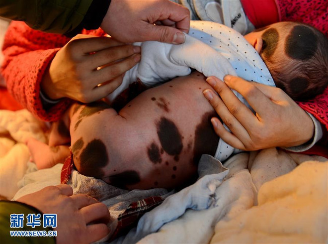 Cảm thương em bé 2 tháng tuổi sống với làn da "quái vật" ảnh 4