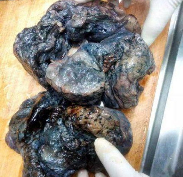 Rợn người với lá phổi xông khói của người hút thuốc 40 năm ảnh 1