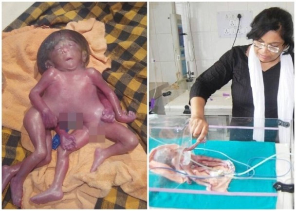 (Nguồn: 163.com) Xót xa người mẹ sinh hạ bé gái dị tật có 4 chân và 4 tay ảnh 1