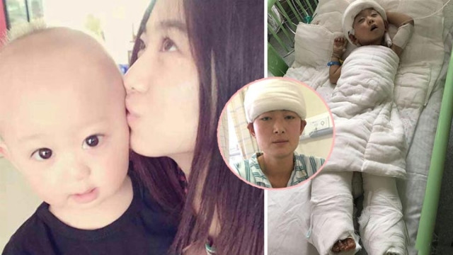 Người mẹ nghèo hiến da đầu cứu con trai bị ngã vào nồi nước sôi ảnh 1