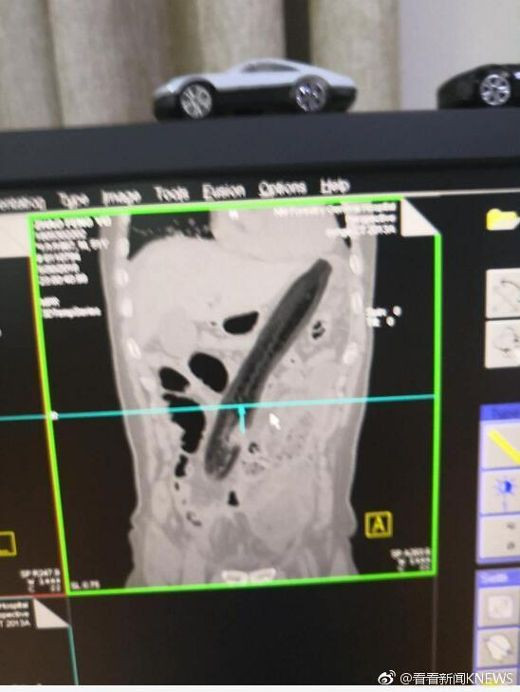 Người đàn ông nhét quả cà tím dài 30cm vào hậu môn để chữa táo bón ảnh 2