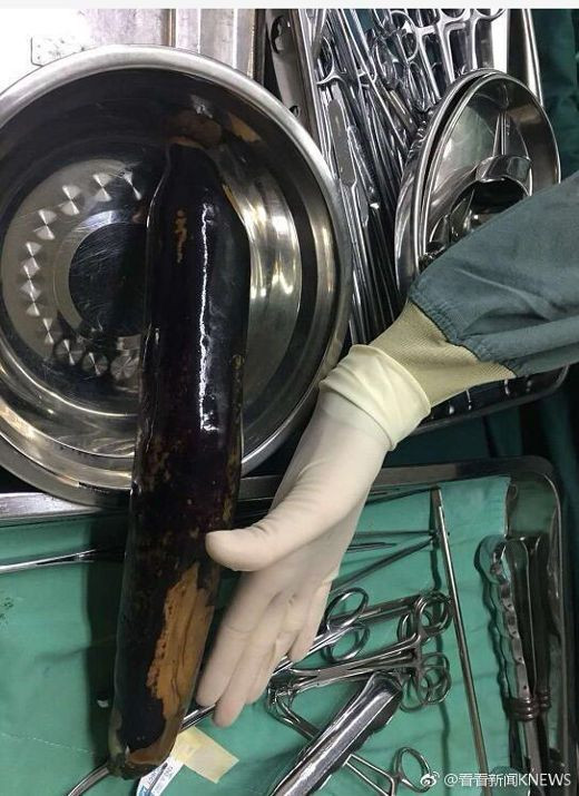 Người đàn ông nhét quả cà tím dài 30cm vào hậu môn để chữa táo bón ảnh 3