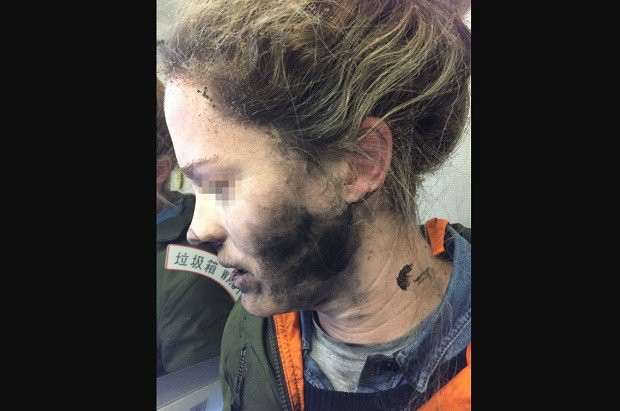 Người phụ nữ bỏng mặt do tai nghe phát nổ trên máy bay ảnh 1