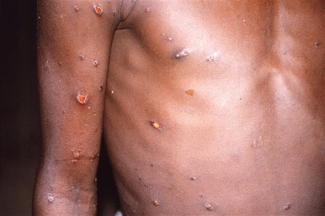 Một bệnh nhân mắc bệnh đậu mùa khỉ tại CHDC Congo. (Ảnh: Reuters/TTXVN) WHO họp khẩn về đợt bùng phát bệnh đậu mùa khỉ ở châu Âu ảnh 1