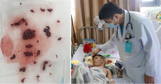 Cần Thơ: Bé trai 4 tuổi bị đột quỵ do huyết khối tĩnh mạch não ảnh 1