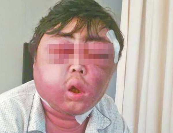 Khuôn mặt của người đàn ông biến dạng sau khi bị muỗi đốt ảnh 1