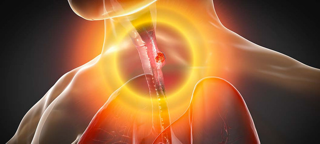 Những phát hiện khoa học mới giúp điều trị ung thư thực quản ảnh 1