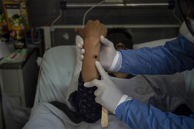 Nốt đậu mùa khỉ trên tay một bệnh nhân. (Ảnh: AFP/TTXVN) Argentina xác nhận ca tử vong đầu tiên do bệnh đậu mùa khỉ ảnh 1