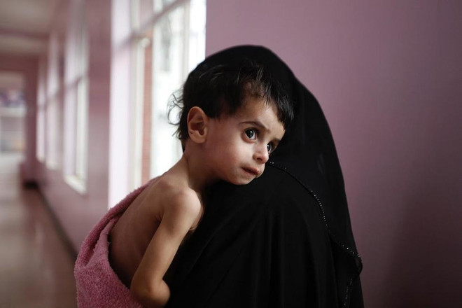 Bạn sẽ rớt nước mắt khi xem những hình ảnh này về Yemen ảnh 7