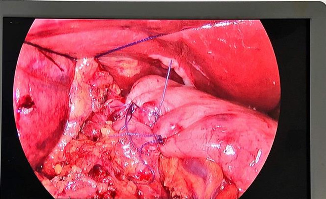 Cấp cứu thành công cho một cụ bà có dạ dày nằm trong lồng ngực ảnh 2