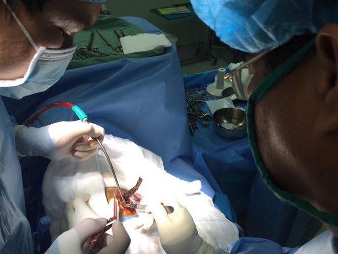 Cần Thơ: Cứu sống bệnh nhân bị thanh sắt đâm xuyên qua sọ ảnh 1