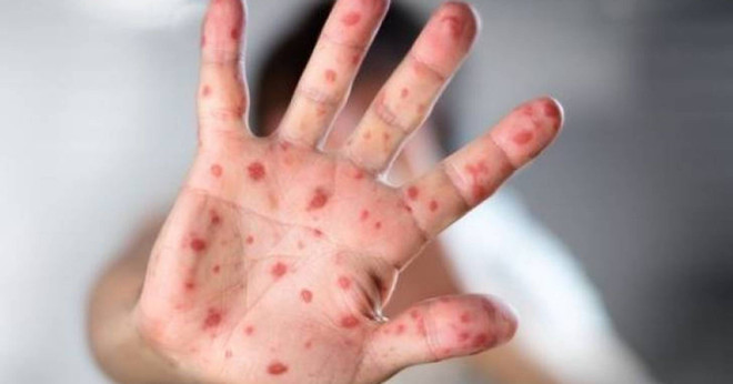 Bùng phát dịch sởi trong nhóm trẻ em người Digan tại Hy Lạp ảnh 1