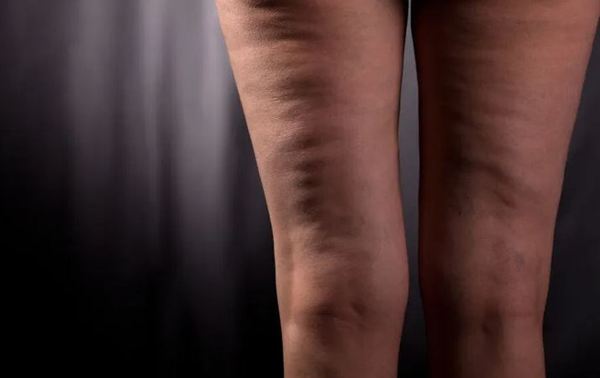 Phương pháp đơn giản để 'hô biến' da sần vỏ cam ở phụ nữ trung niên ảnh 1