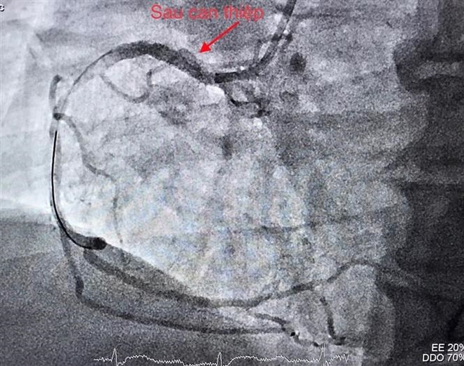 Cứu sống bệnh nhân bị nhồi máu cơ tim và nhồi máu não hiếm gặp ảnh 2