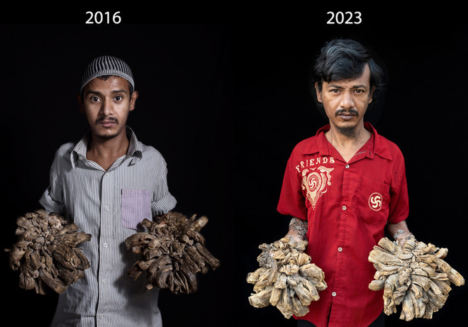 Người cây Bangladesh: 'Án chung thân' trong 'nhà tù cơ thể' ảnh 2