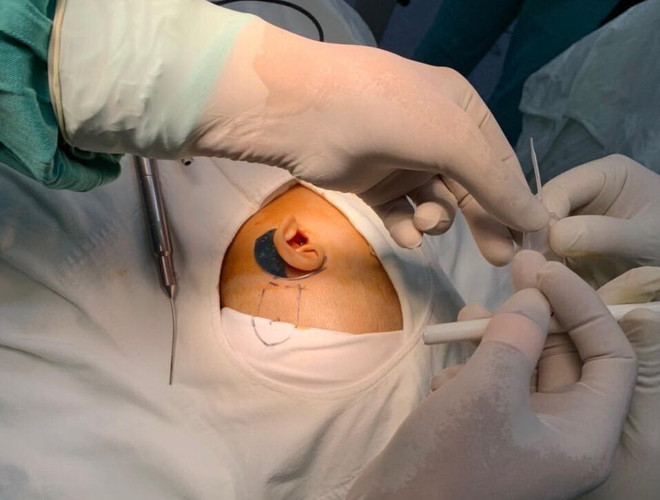 Bệnh viện Trung ương Huế tặng bệnh nhi bộ cấy trong ốc tai điện tử ảnh 2