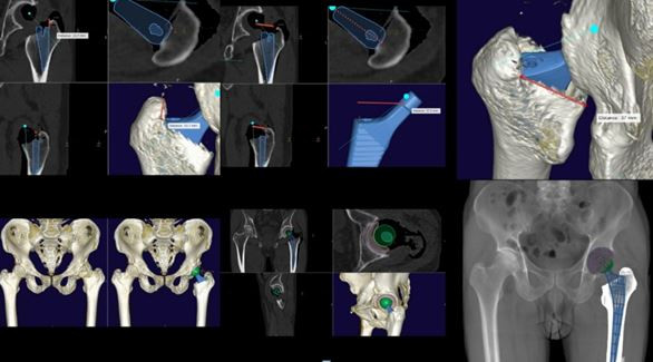 Ứng dụng thành công kỹ thuật 'cá thể hóa' thay khớp háng '4 không' ảnh 1