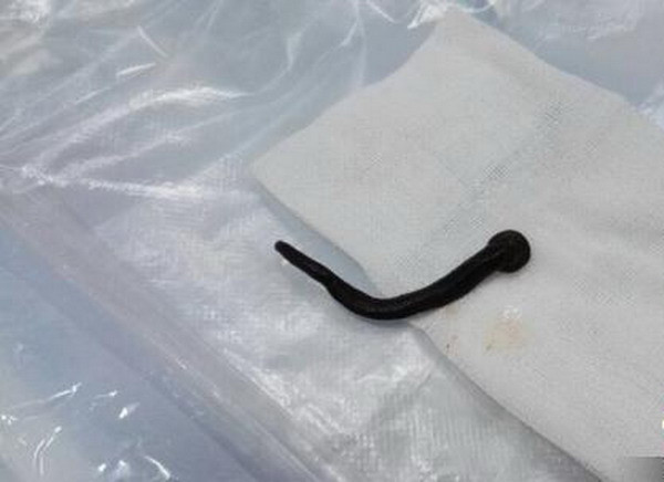 Rùng rợn gắp con đỉa sống dài 6cm từ khí quản người đàn ông ảnh 1