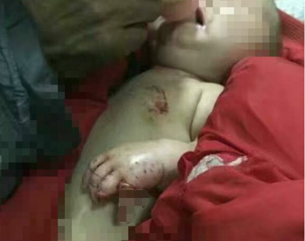 Kinh hoàng em bé bị chó ăn mất ngón tay khi ở nhà cùng anh trai 4 tuổi ảnh 1