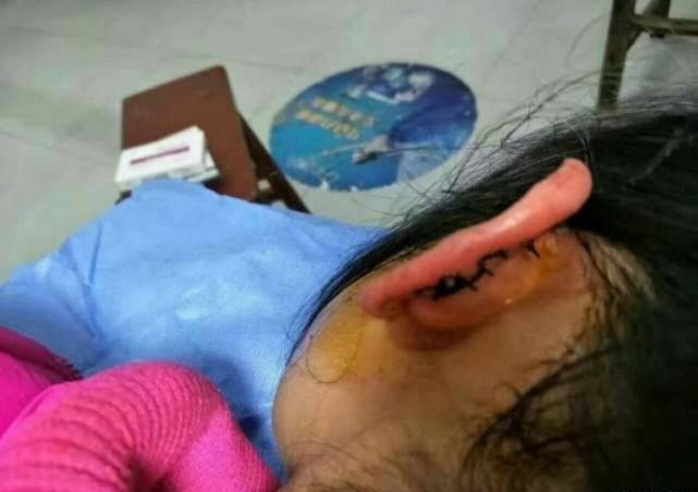 Bé gái lớp 2 bị cô giáo véo đến đứt tai vì không hoàn thành bài tập ảnh 1