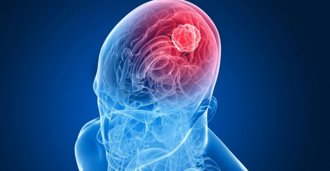 Tín hiệu vui cho những bệnh nhân đang điều trị ung thư não ác tính ảnh 1
