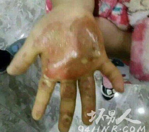 Mẹ đẻ nhúng tay con gái vào nước sôi, rắc muối vào vết thương ảnh 1