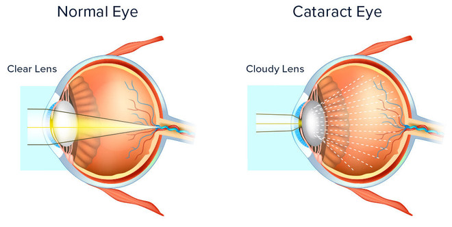 Dấu hiệu suy giảm thị lực có thể cảnh báo bệnh mất trí nhớ khi về già ảnh 2