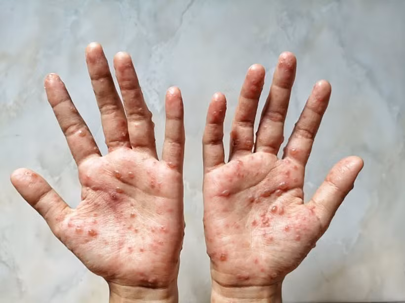 Một bệnh nhân bị mắc bệnh đậu mùa khỉ. (Ảnh: Shutterstock/TTXVN)