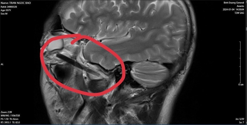 Hình ảnh dị vật trong mắt người đàn ông ở tỉnh Bình Dương. (Ảnh: TTXVN phát)