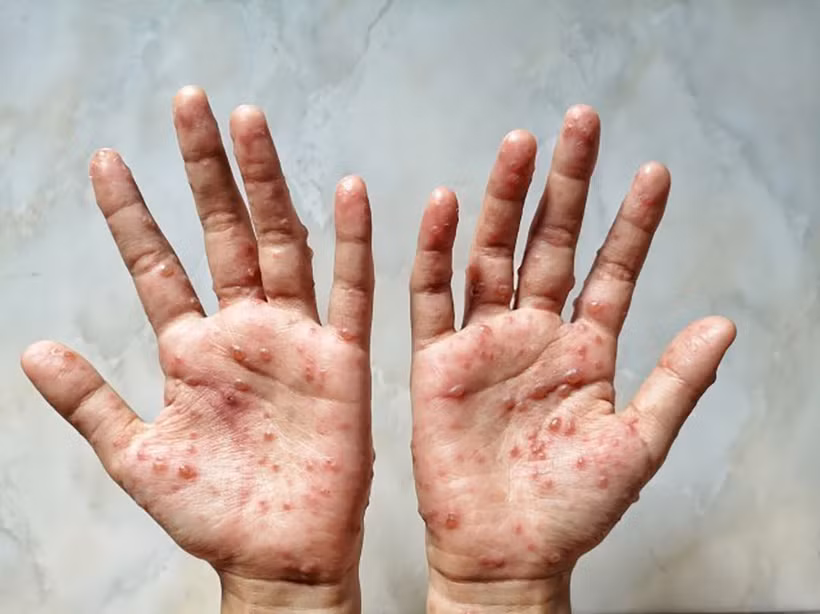 Một bệnh nhân bị mắc bệnh đậu mùa khỉ. (Ảnh: Shutterstock/TTXVN)