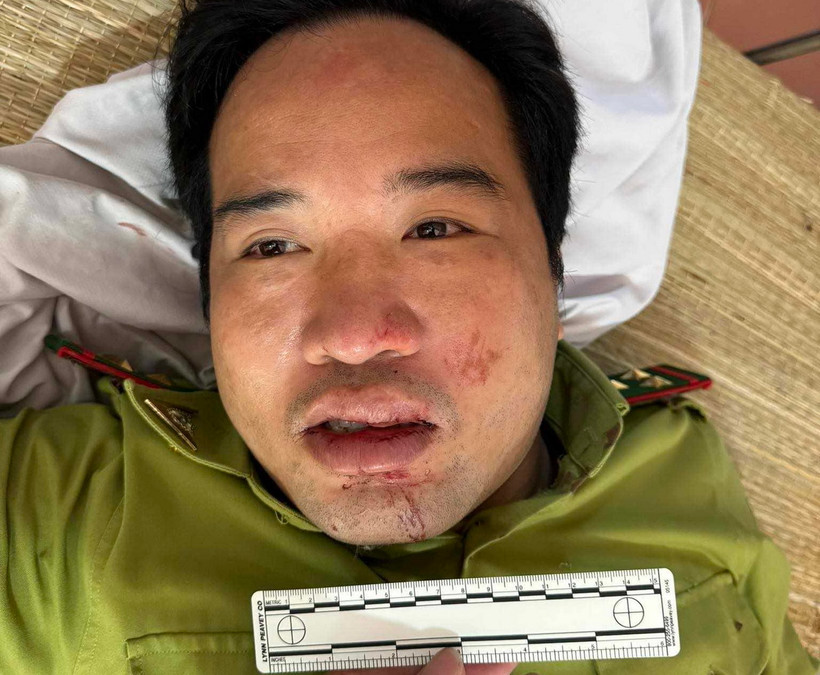 Trạm trưởng Kiểm lâm Trung Lý (huyện Mường Lát) Lê Duy Cường đang được cấp cứu tại Bệnh viện Đa khoa huyện Mường Lát. (Ảnh: TTXVN phát)