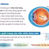 Chủ động khám mắt định kỳ để chẩn đoán sớm bệnh bệnh Glôcôm