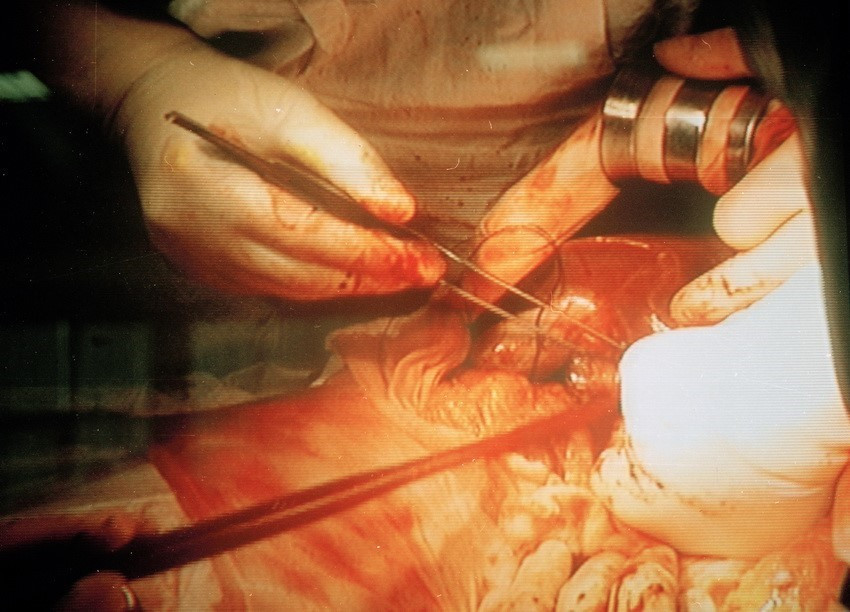 Nhiều kỹ thuật chuyên môn cao được thực hiện thành công tại nhiều bệnh viện trung ương như ghép tạng, nội soi, phẫu thuật bằng robot, chuyển giao một số kỹ thuật cho bệnh viện tuyến tỉnh, huyện...Trong ảnh: Ca mổ ghép gan đầu tiên của Việt Nam với sự tham gia của 120 Giáo sư, Tiến sỹ, Bác sỹ, kỹ thuật viên của Viện Quân y, bệnh viện Nhi và bệnh viện Chợ Rẫy được thực hiện tại Viện Bỏng Quốc gia, năm 2004. (Ảnh: Hữu Oai/ TTXVN)