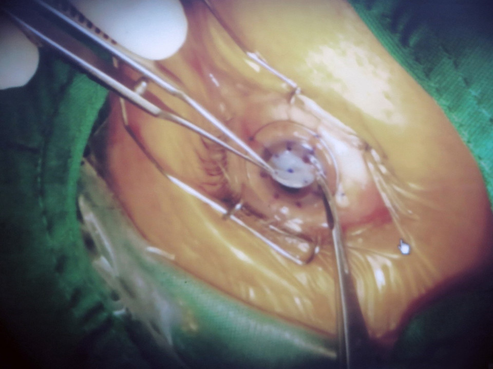 Lần đầu tiên, các bác sỹ Bệnh viện Chợ Rẫy (Thành phố Hồ Chí Minh) thực hiện thành công ca phẫu thuật phối hợp hai trong một: vừa ghép giác mạc vừa lấy thủy tinh thể và đặt thủy tinh thể nhân tạo trong cùng một lần. Việc phối hợp sẽ giúp bệnh nhân không phải trải qua nhiều cuộc phẫu thuật và sớm có lại thị lực tốt nhất. (Ảnh: Đinh Hằng/TTXVN)