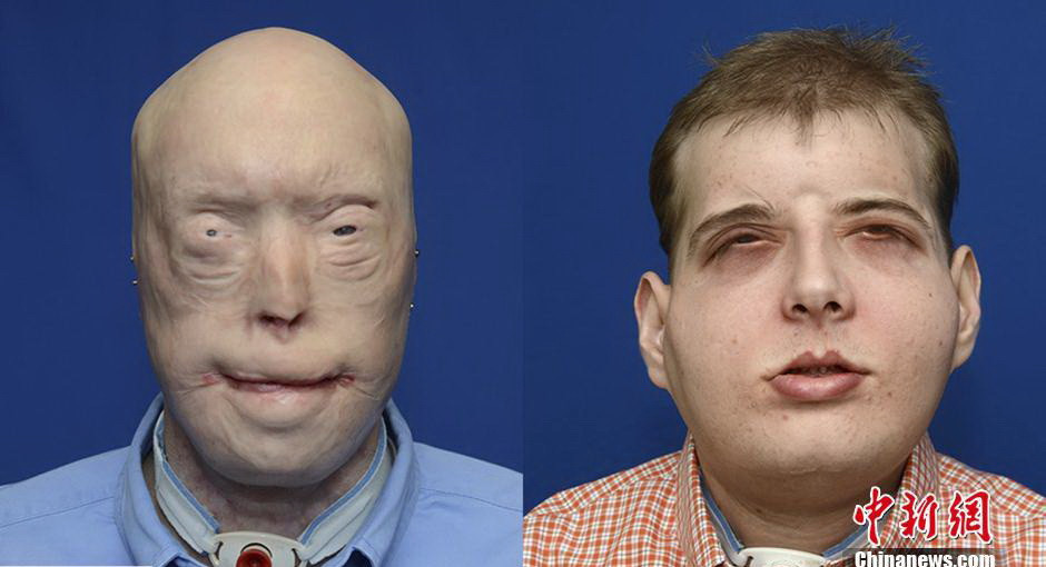 Ngày 16/11, Trung tâm y học thuộc Đại học New York, Mỹ đã tổ chức buổi họp báo công bố thực hiện thành công ca phẫu thuật mặt phức tạp nhất tính đến thời điểm này. Người bệnh là Patrick Hardison, nhân viên cứu hỏa, đến từ Mississippi. Khuôn mặt của anh bị biến dạng trong một tai nạn khi chữa cháy. Trải qua 26 giờ đồng hồ trên bàn phẫu thuật cùng 100 bác sỹ, y tá và nhân viên khác, cuộc phẫu thuật cuối cùng đã thành công. (Nguồn: Chinanews.com)