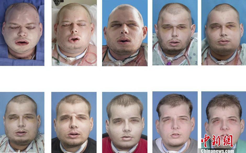 Khuôn mặt của Patrick Hardison thay đổi qua từng giai đoạn phẫu thuật. (Nguồn: Chinanews.com)