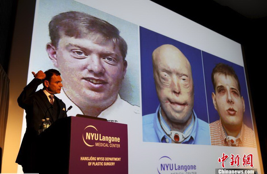 Giáo sư Eduardo D. Rodriguez đến từ trung tâm y học, Đại học New York, bác sỹ mổ chính, giới thiệu những thông tin liên quan đến cuộc phẫu thuật. (Nguồn: Chinanews.com)