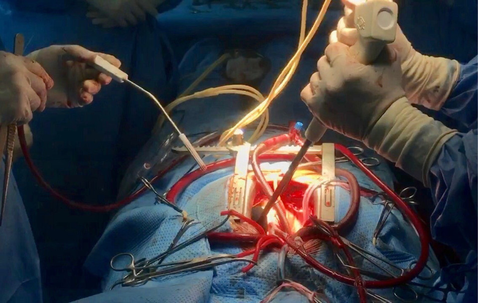 Ngày 17/9, sau ca phẫu thuật kéo dài hơn 2 giờ, các bác sỹ khoa Phẫu thuật tim đã bóc tách toàn bộ khối u nhầy, tái tạo vách liên nhĩ bằng màng tim cho bệnh nhân K. (Ảnh: Thanh Sang/TTXVN)