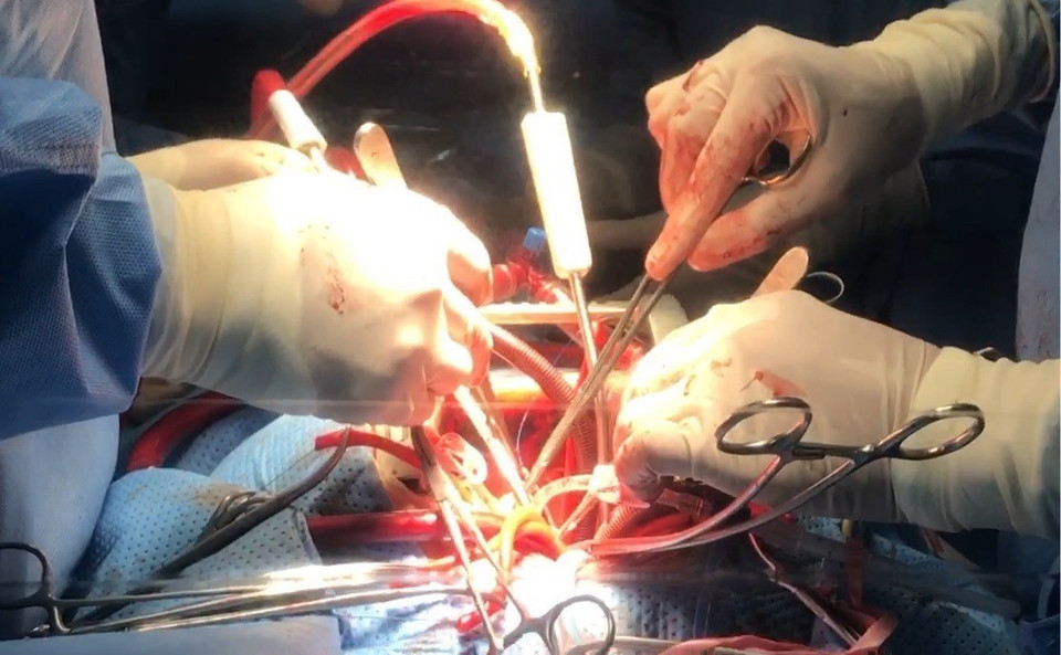 Bệnh nhân là ông Nguyễn Văn K (63 tuổi, ở Sóc Trăng) nhập viện với kết quả siêu âm tim cho thấy bệnh nhân K có khối u nhầy nhĩ phải đường kính 40x25mm, có cuống xuất phát từ vách liên nhĩ, dao động liên tục đe dọa lấp van 3 lá. (Ảnh: Thanh Sang/TTXVN)