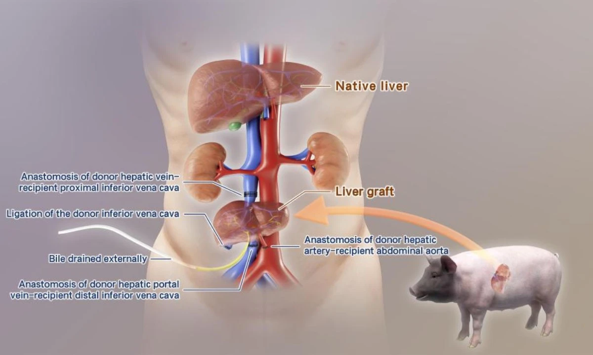 Phương pháp điều trị suy gan truyền ngoài cơ thể với gan lợn chỉnh sửa gene