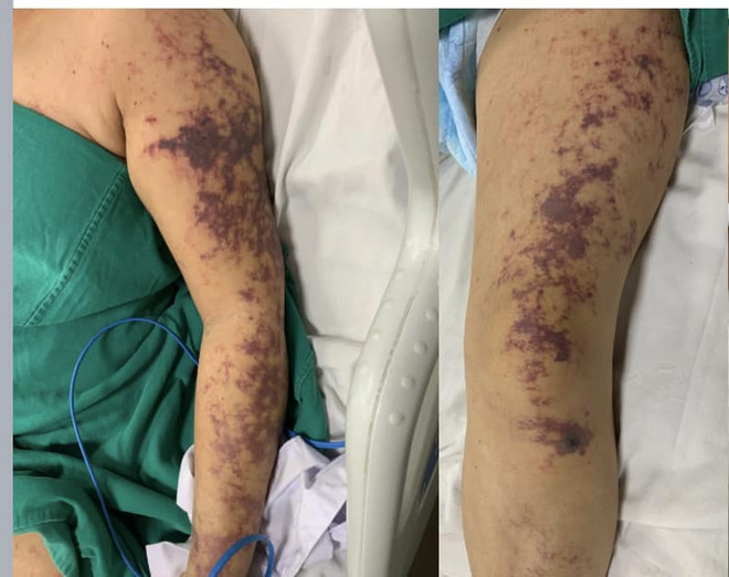 Một phụ nữ mắc liên cầu lợn tình trạng nguy kịch sau khi ăn lòng ảnh 1