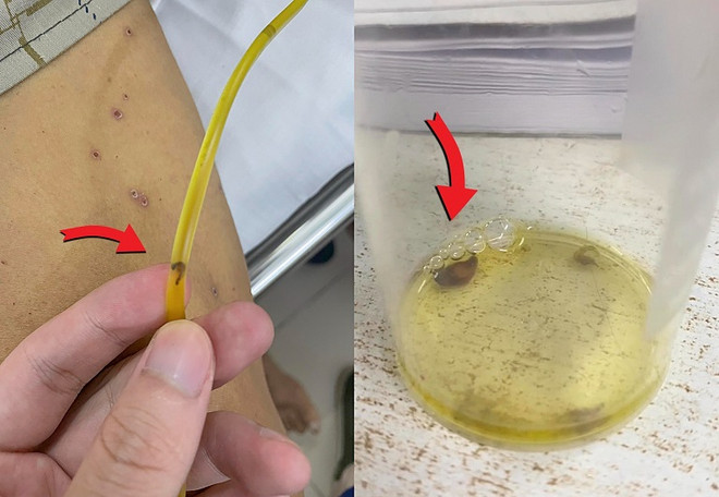 Người đàn ông đầy sán lá gan gây tắc mật do thói quen ăn gỏi cá ảnh 1