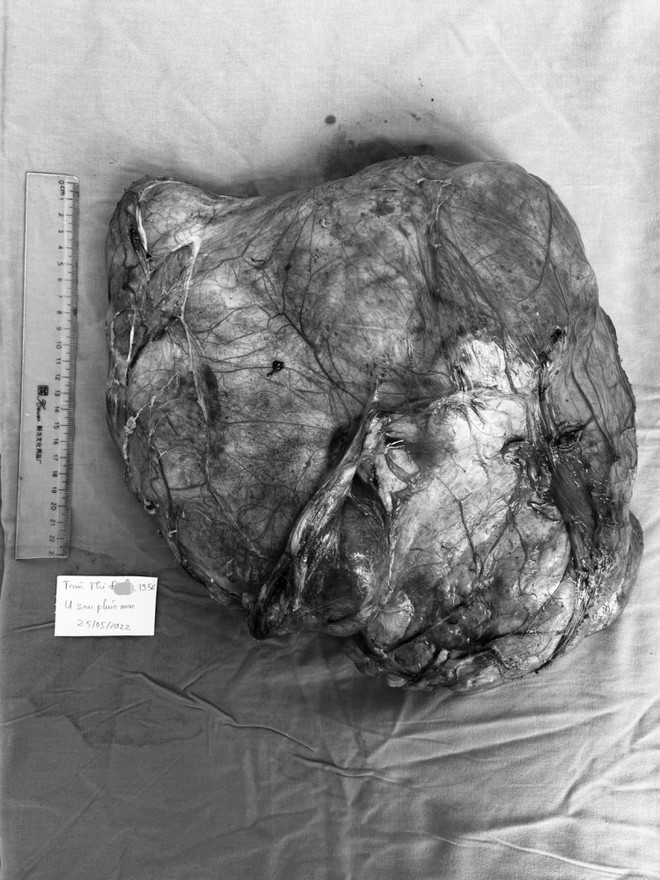 Phẫu thuật thành công loại bỏ khối u kích thước tới 40cm ở ổ bụng ảnh 2