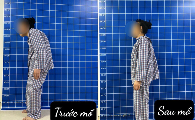Nhiều giờ phẫu thuật thành công nắn chỉnh gù lưng cho bệnh nhân có HIV ảnh 1