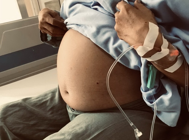 Bác sỹ Bệnh viện K bóc tách khối u nặng gần 10kg cho nữ bệnh nhân ảnh 1