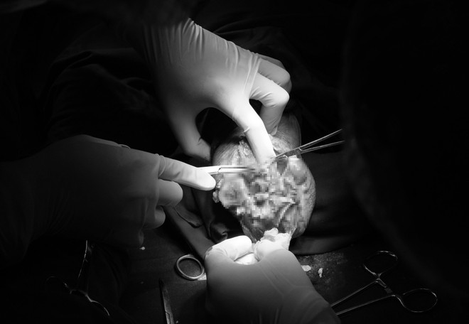 Nam bệnh nhân bị cắt cụt 2 cẳng chân do biến chứng đái tháo đường ảnh 1