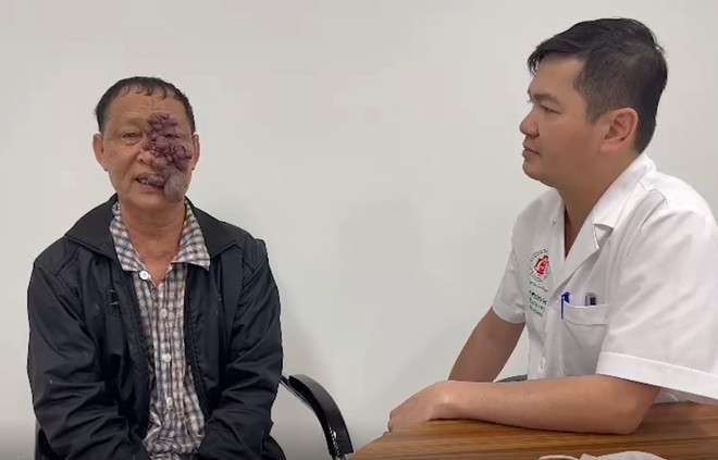 Phẫu thuật cắt khối u như chùm nho trên mặt một người đàn ông ảnh 2