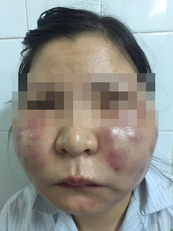 Biến dạng khuôn mặt sau khi tiêm thuốc làm trắng da ảnh 1